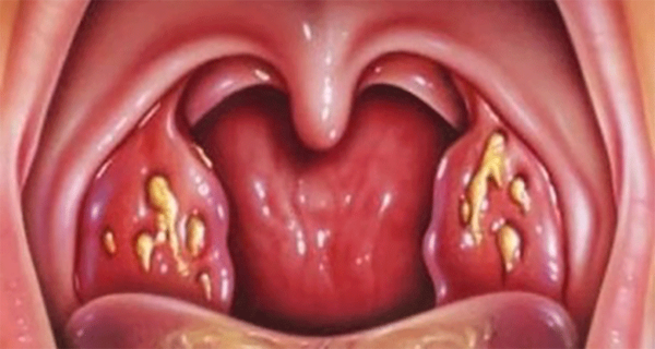 Как избавиться от боли в горле натуральными средствами