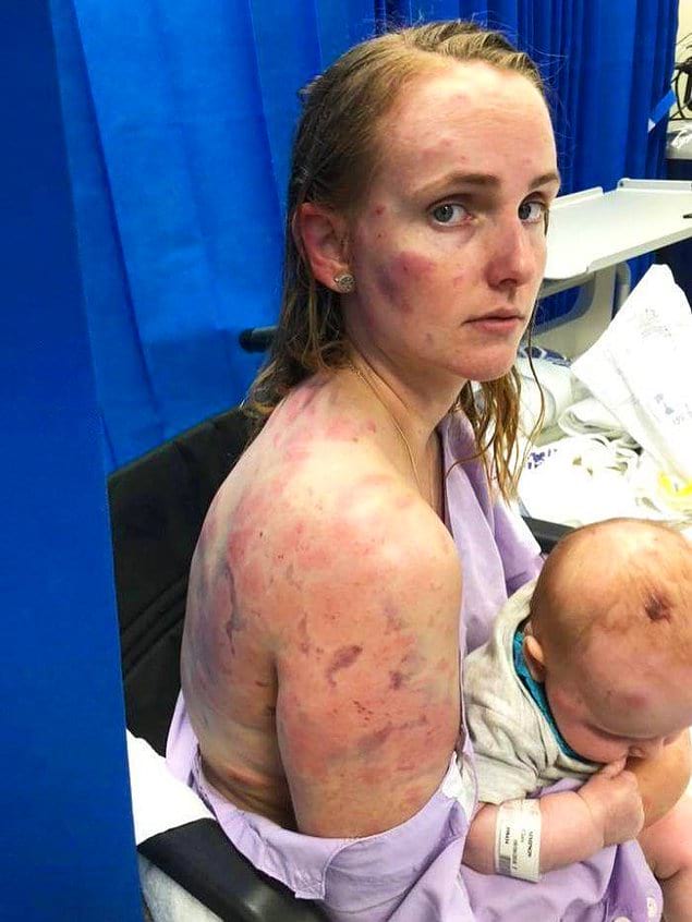 Австралийской женщине пришлось стать щитом для своего малыша, спасая его от града размером с теннисный мяч