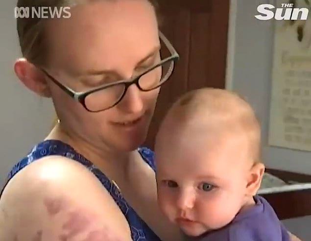 Австралийской женщине пришлось стать щитом для своего малыша, спасая его от града размером с теннисный мяч